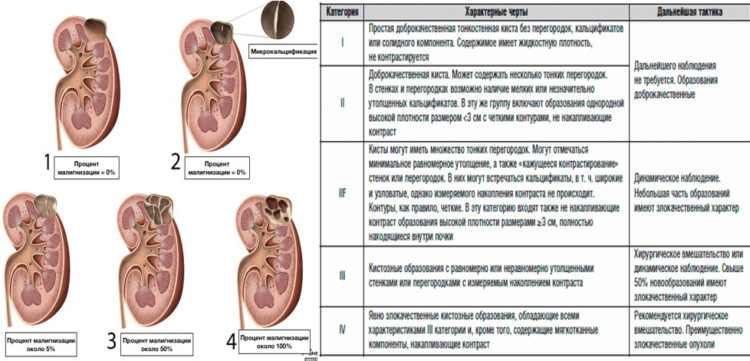 Киста паренхимы почки. Синусные кисты почек классификация. Классификация кист почек по Bosniak. Классификация Bosniak кисты почек. Классификация Босняк почки.